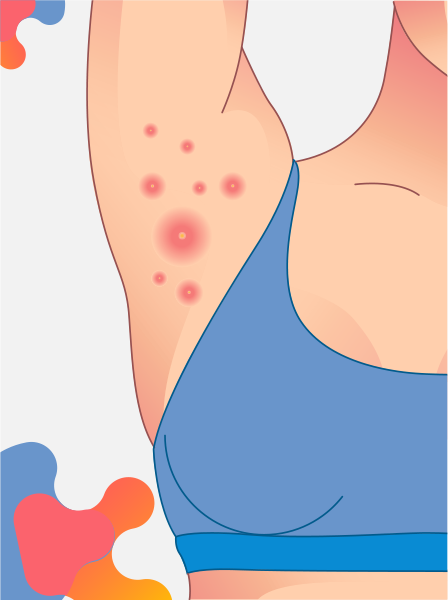 Hidradenitis Supurativa: Información médica especializada con MedForum Conoce qué es la hidradenitis supurativa axilar con MedForum